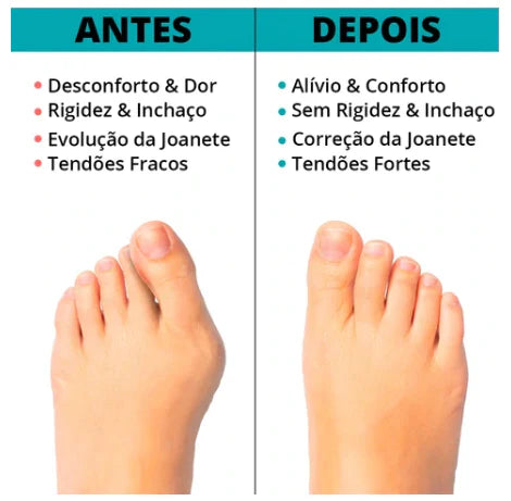 Corretor de Joanete Silicone Ortopédico